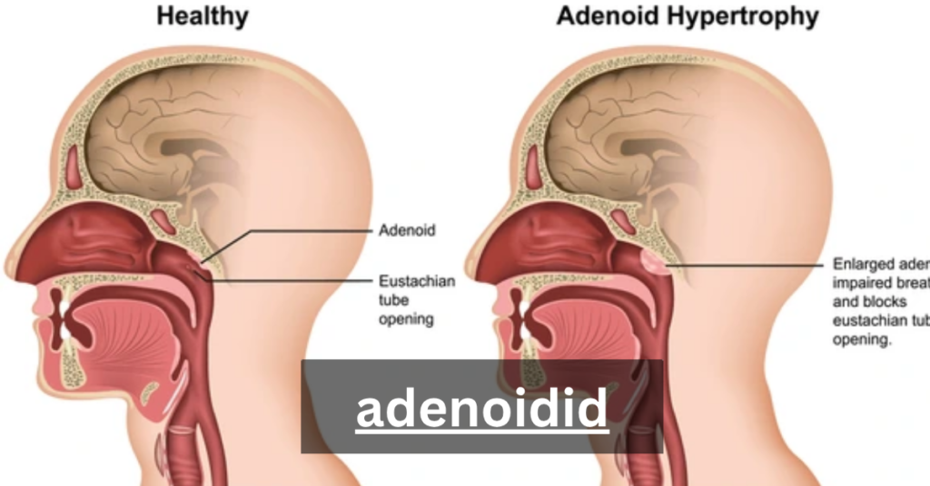 adenoidid